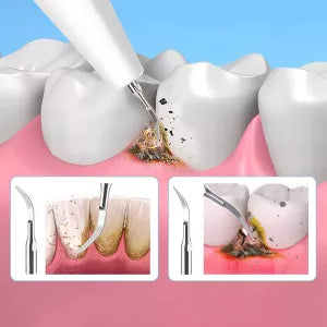 Ultrasonic scaler