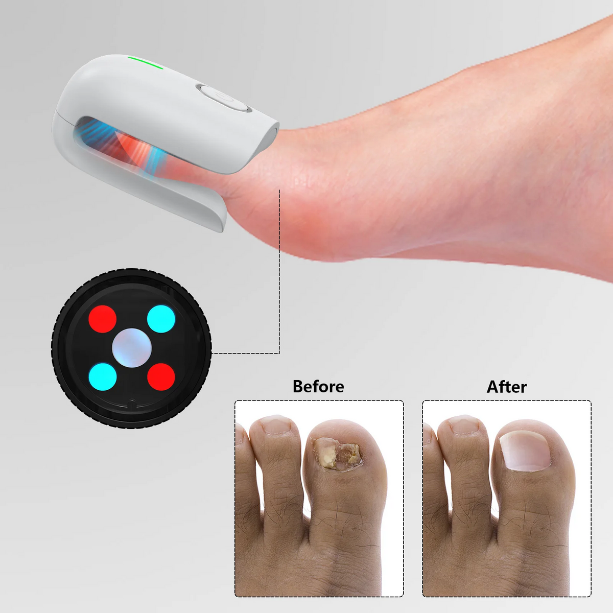 Portable Nail Fungus Removal Device – Treat Nail Discoloration and Thickening Safely at Home with Advanced Anti-Fungal Technology