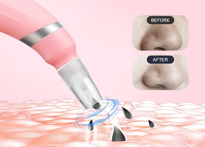 Diamond Microdermabrasion Facial Device - Portable Exfoliation Vacuum for Deep Cleaning, Blackhead Removal, and Glowing Skin Care