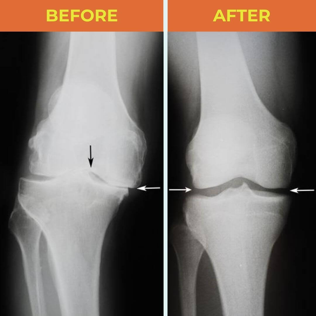People All Around The Lahore Are Using The Nooro 3-in-1 Knee Massager To Keep Knee Pain At Bay