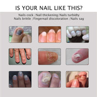 Nail Repair Treatment Gel