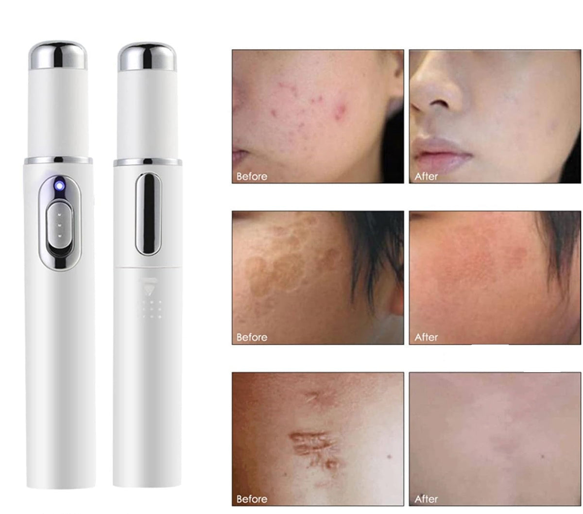 Scar Removal Phototherapy Pen – Asia’s Best-Selling Expert-Recommended Device for Fading Old Scars & Stretch Marks