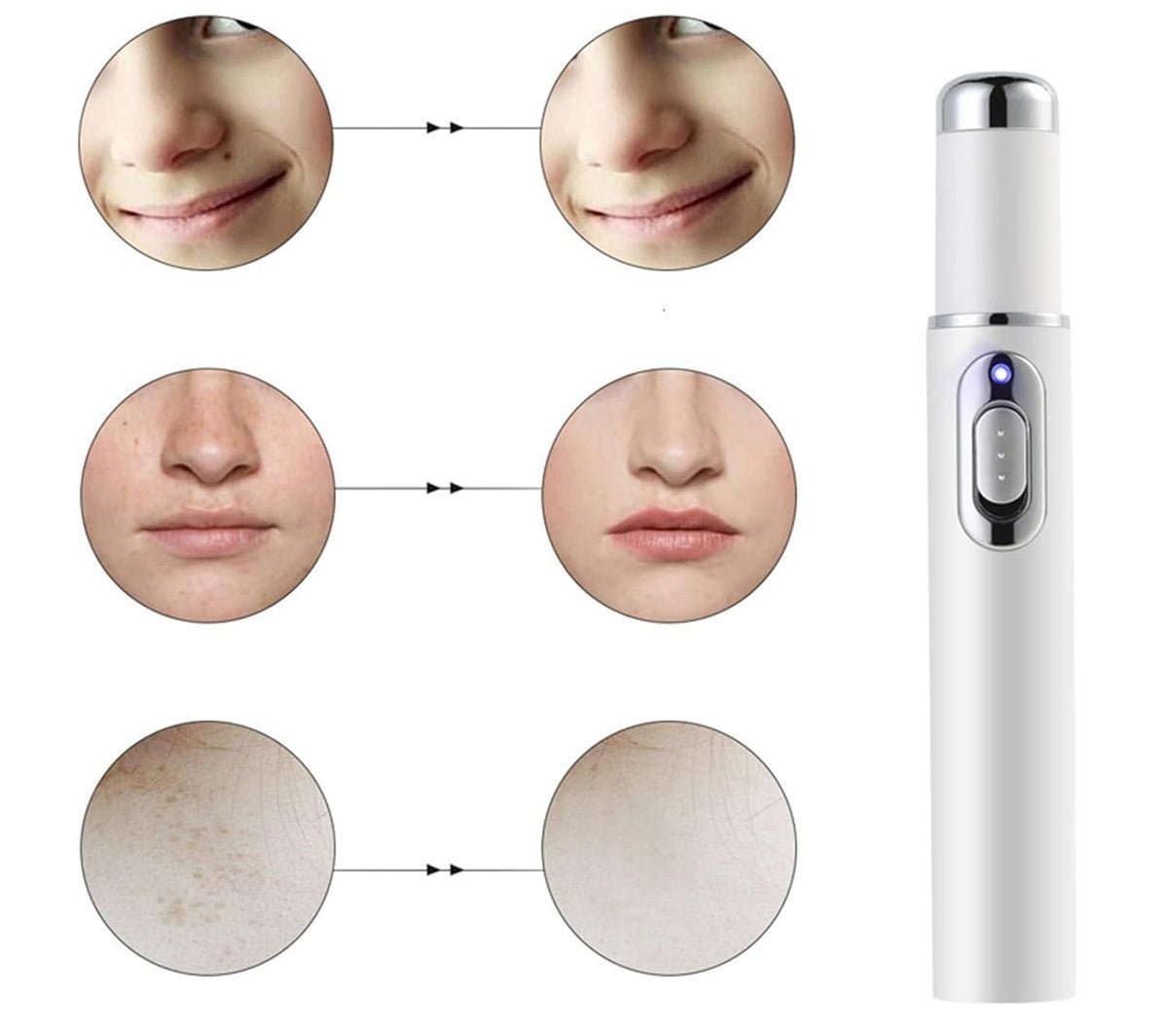 Scar Removal Phototherapy Pen – Asia’s Best-Selling Expert-Recommended Device for Fading Old Scars & Stretch Marks
