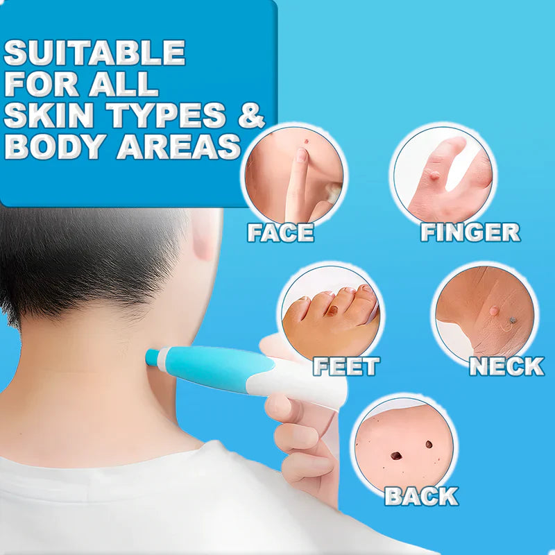 Painless Skin Tag Remover