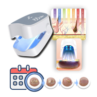Painless laser treatment for nail fungus