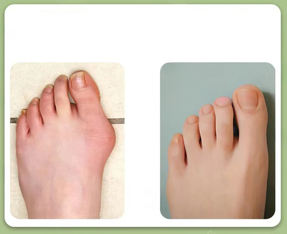 Electric Bunion Corrector – Vibration Massager with Adjustable Brace for Hallux Valgus Relief, Toe Straightening, and Foot Care