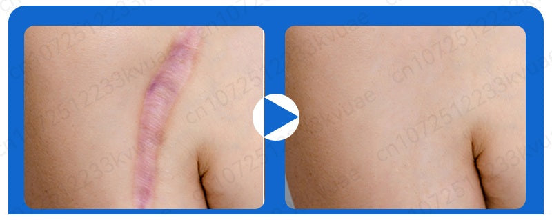 Scar Removal Phototherapy Pen – Asia’s Best-Selling Expert-Recommended Device for Fading Old Scars & Stretch Marks