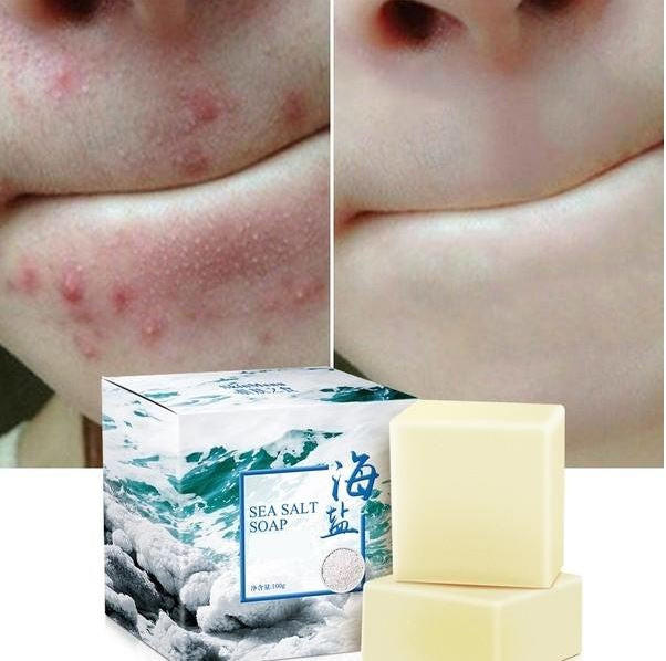 Sea Salt Soap - Acne Treatment