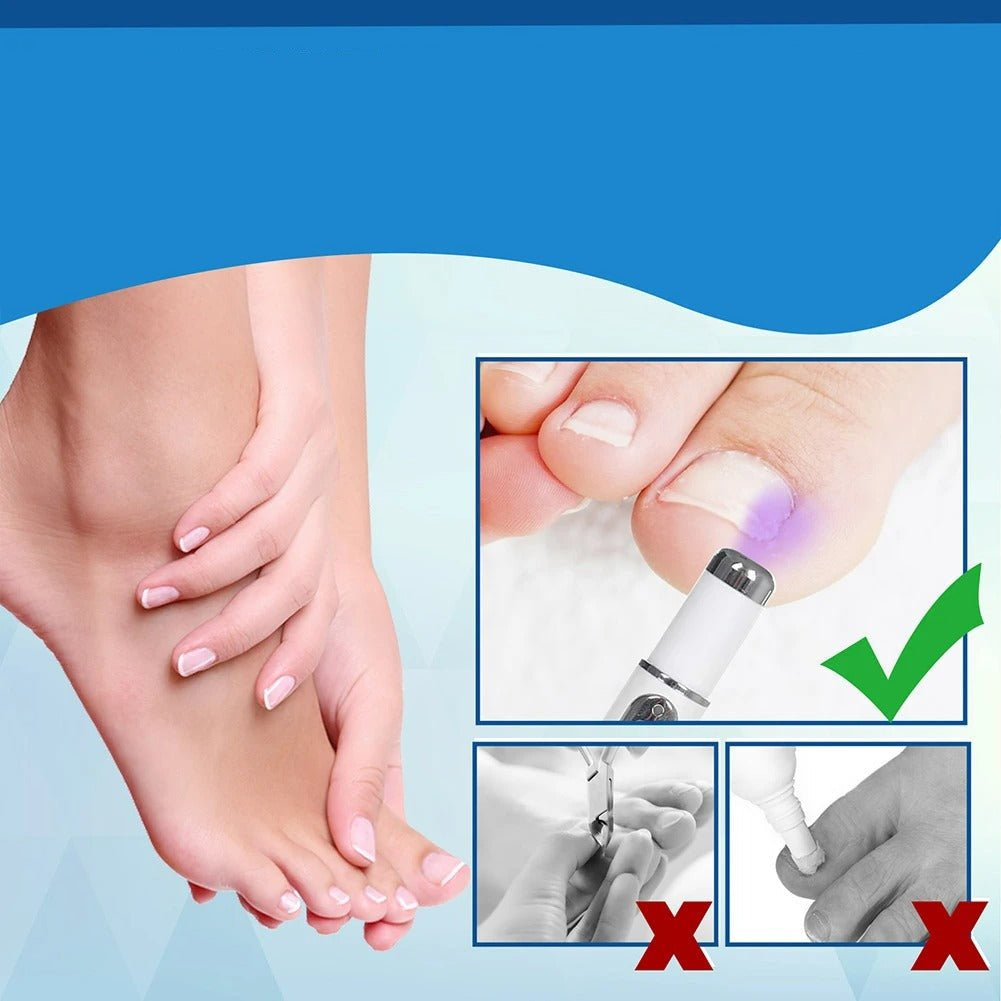 Antifungal Laser Device - Nail Fungus Treatment Pen Anti-fungal Repair Pen Blue Light Laser Pen
