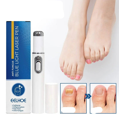 Antifungal Laser Device - Nail Fungus Treatment Pen Anti-fungal Repair Pen Blue Light Laser Pen