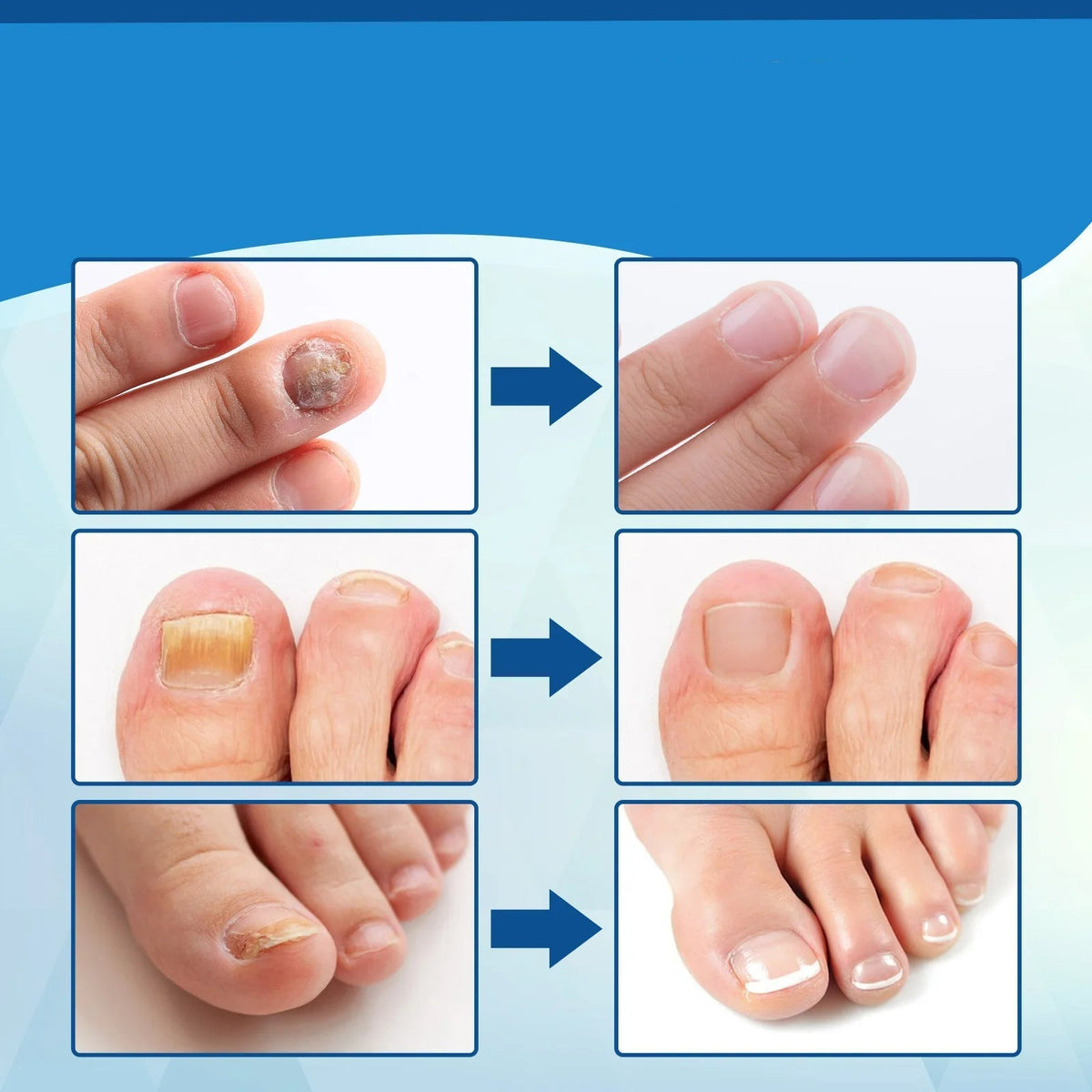 Antifungal Laser Device - Nail Fungus Treatment Pen Anti-fungal Repair Pen Blue Light Laser Pen