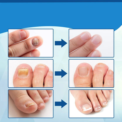 Antifungal Laser Device - Nail Fungus Treatment Pen Anti-fungal Repair Pen Blue Light Laser Pen